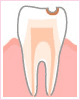 C1:初期～エナメル質の虫歯～