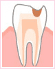 C2:中期～象牙質の虫歯～