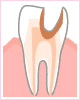 C3:後期～神経まで進行した虫歯～