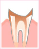 C4:末期～神経まで進行した虫歯～