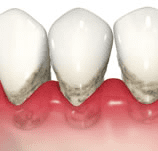 中度の歯周炎
